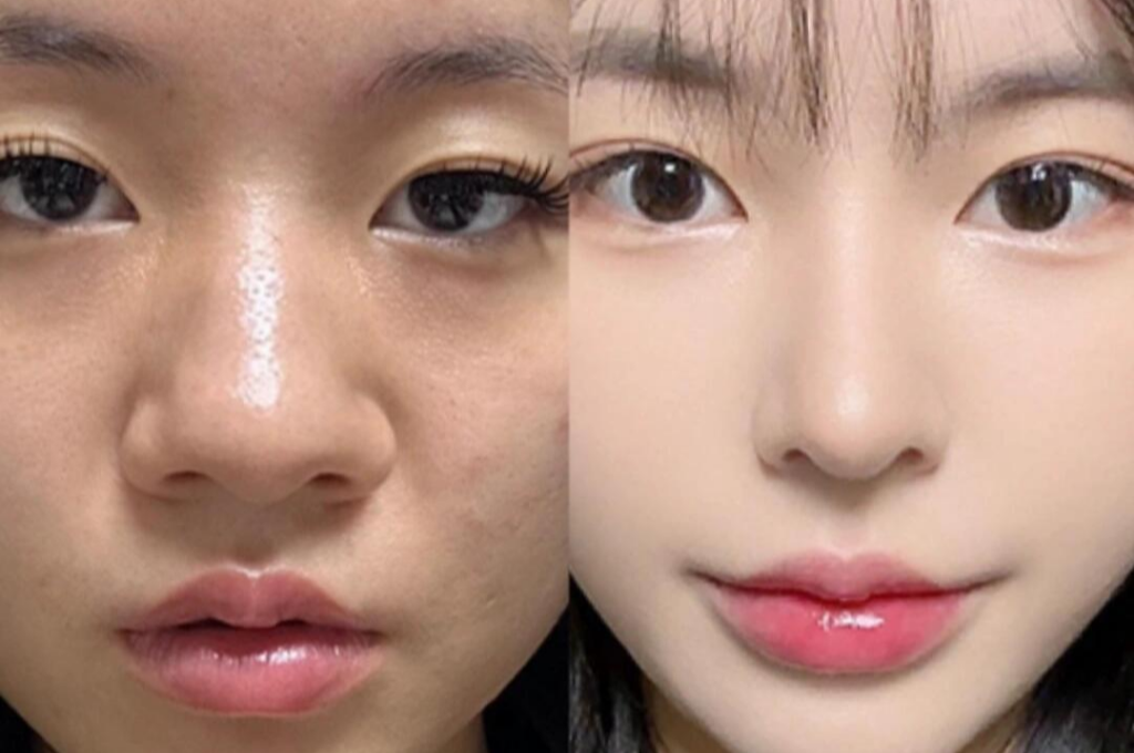 What Are the Symptoms of “Periocular Laxity / Crepey Texture”?