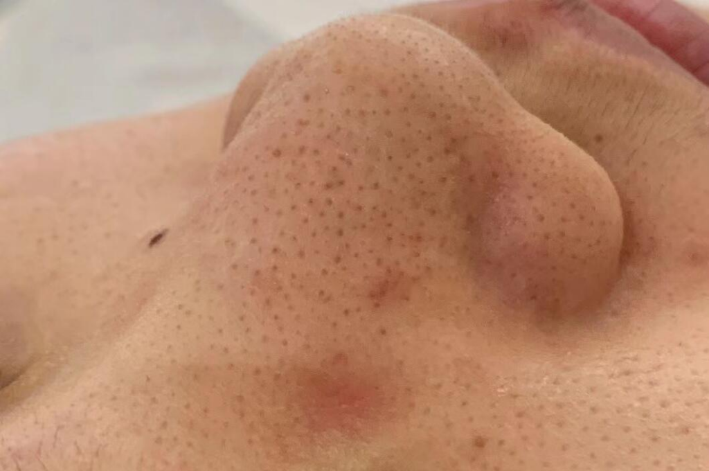 What Are the Symptoms of “Couperose / Redness”?