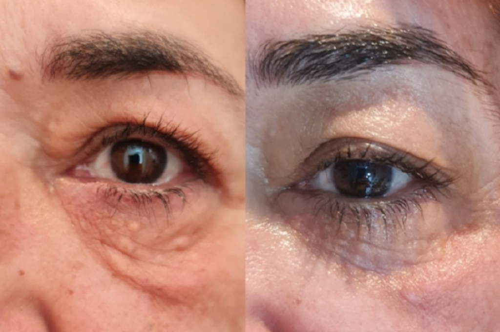 What Are the Symptoms of “Laxity / Soft Jawline / Mild Sagging”?