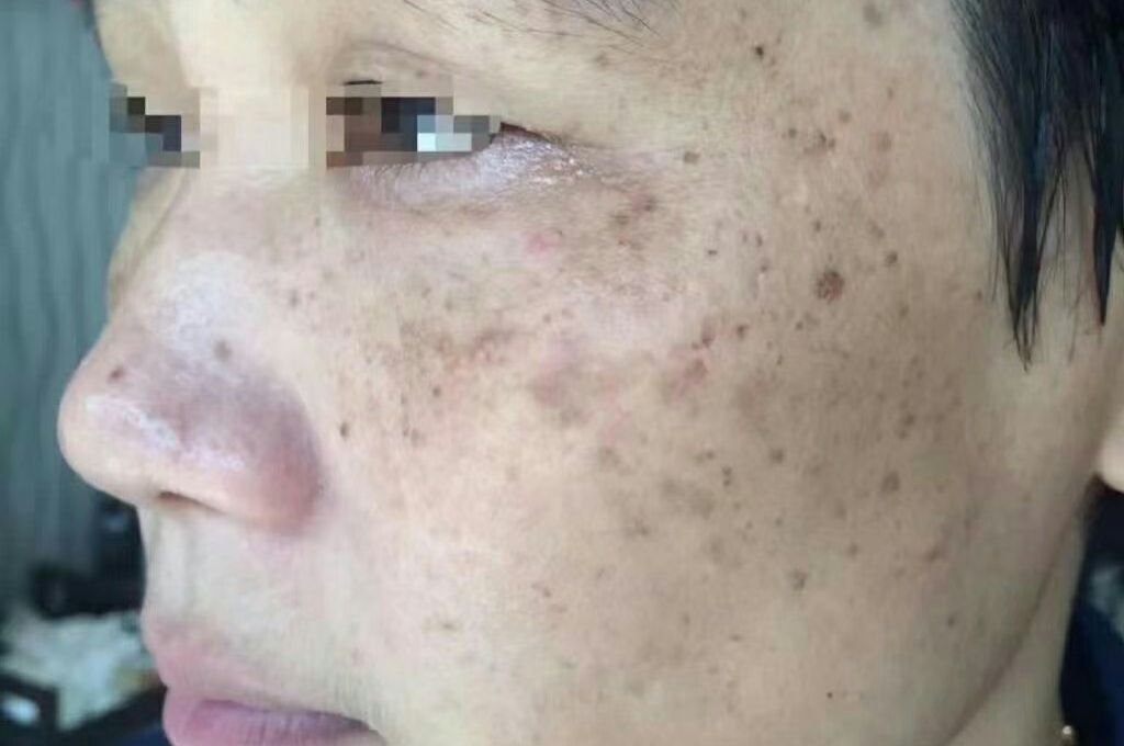 What Are the Symptoms of “Uneven Skin Tone”?