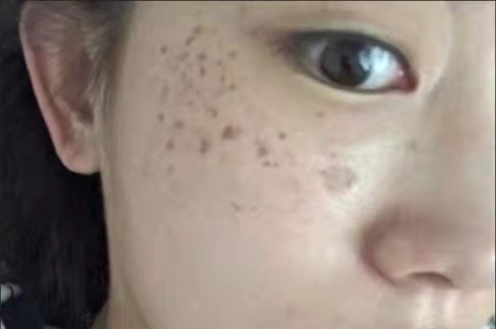 What Are the Symptoms of “Pigmentation & Melasma”?
