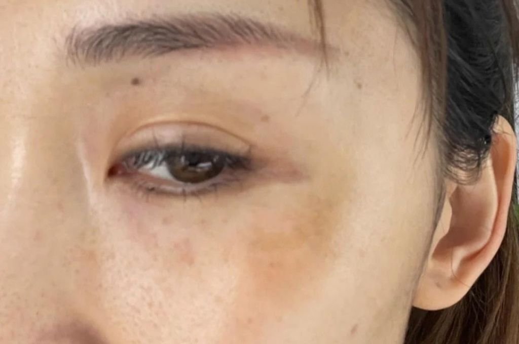 What Are the Symptoms of “Wrinkles & Fine Lines”?