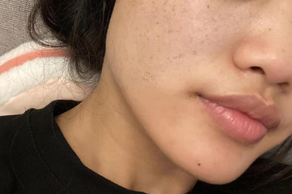 What Are the Symptoms of “Flat, Tired Complexion”?