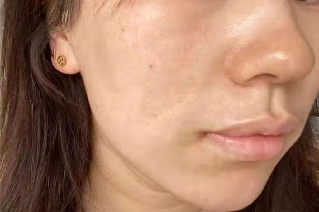 What Are the Symptoms of “Neck Laxity / Neck Lines”?