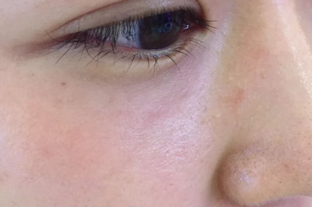 What Are the Symptoms of “Early Signs of Aging”?